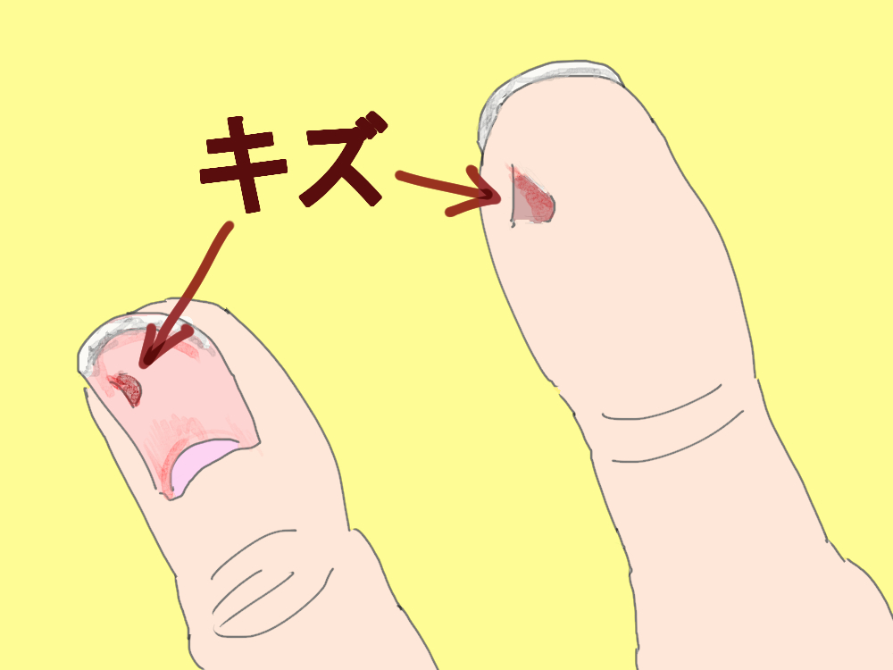 イラスト、シマリスに噛まれた直後の親指。爪側と指の腹側。